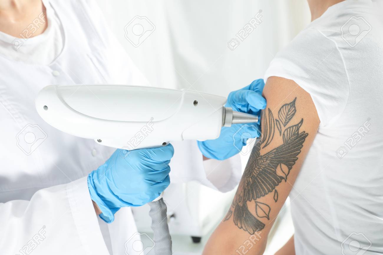 Tattoo Removal