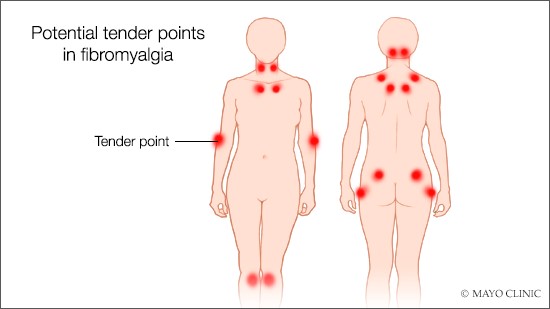 Fibromyalgia symptoms