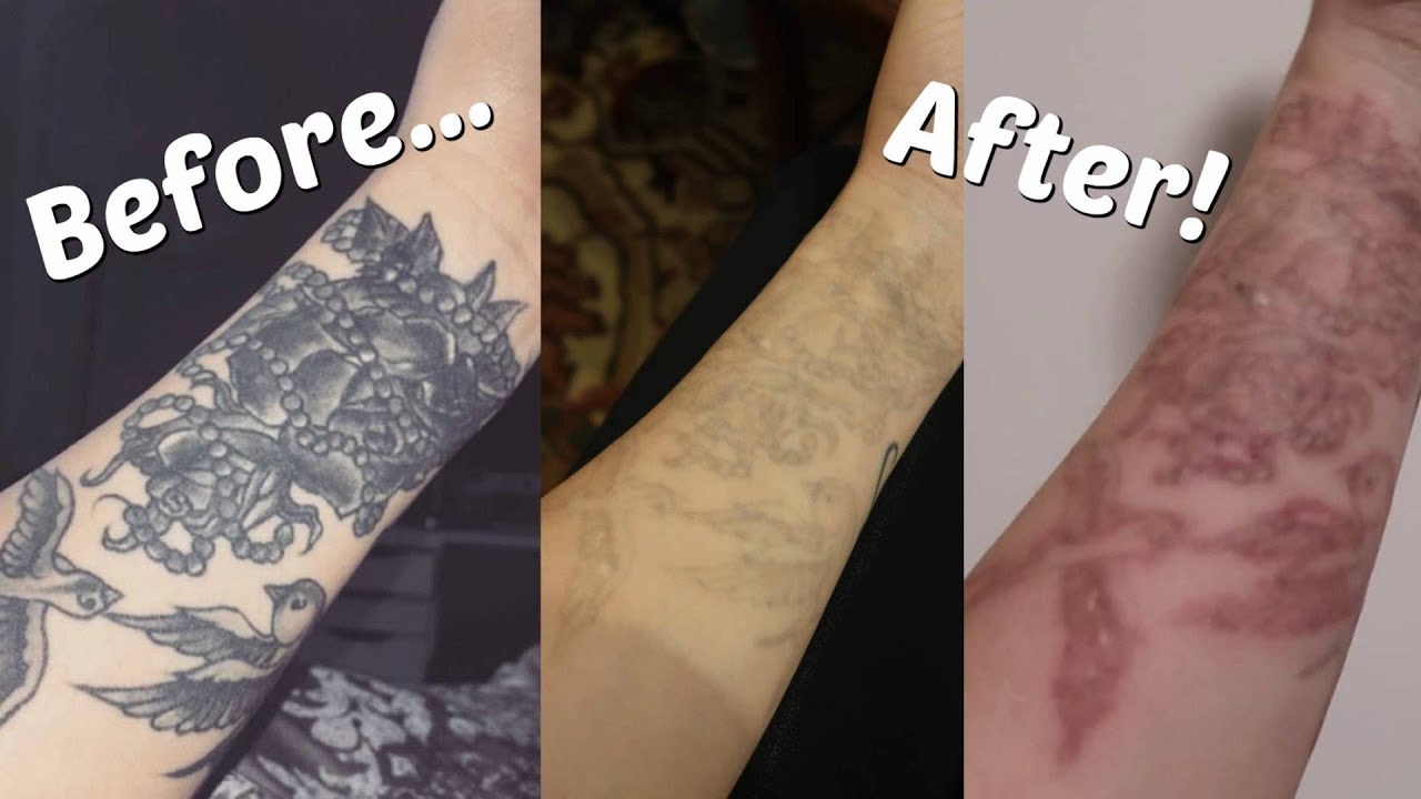 Tattoo Removal